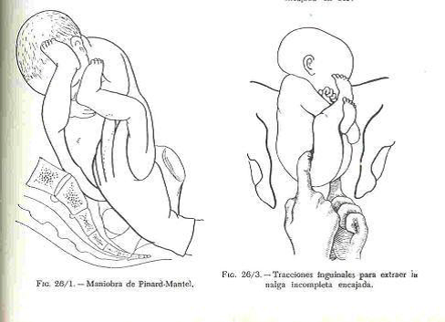 pinard maniobra parto maniobras podalico parcial obste pelvica extraccion primer mauriceau cavity yolk lies primary